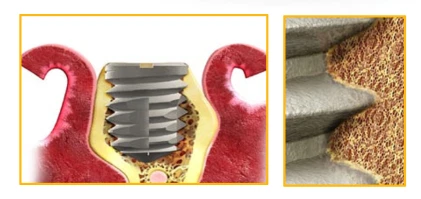 Titamax WS Cortical
