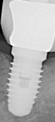 Nobel Replace External Hex (4.3) (Steri-Oss)