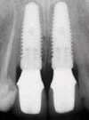 Nobel Replace -Taper WP (5.0)