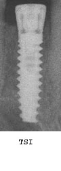 TSI (3.25)