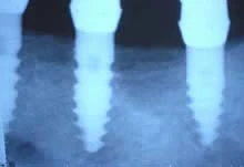 SDI