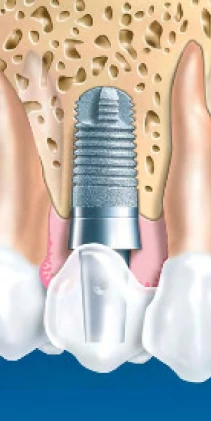 Impla Benner Screw (5.3)