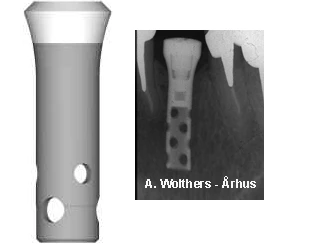 Hollow Cylinder Esthetic Plus 3.5 (4.8)