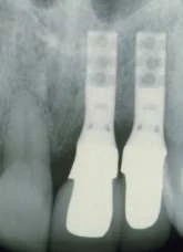 Hollow Cylinder Esthetic Plus 3.5 (4.8)