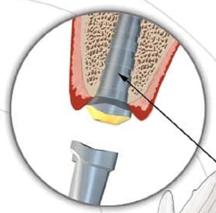 Anatomic (AW)