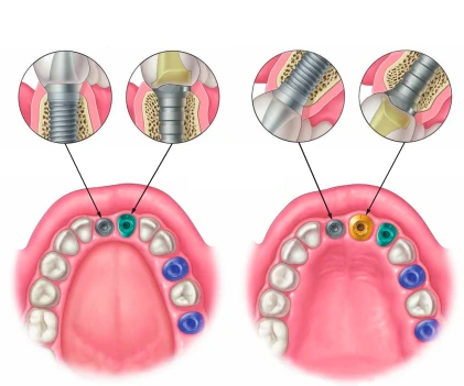 Anatomic (AW)