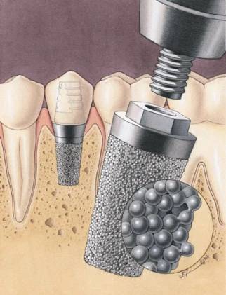 Endopore External Hex (3.5)