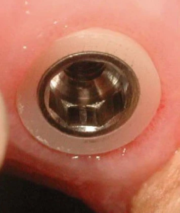 Z1 Conic (6.0)