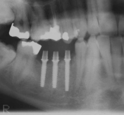 Nanoimplant