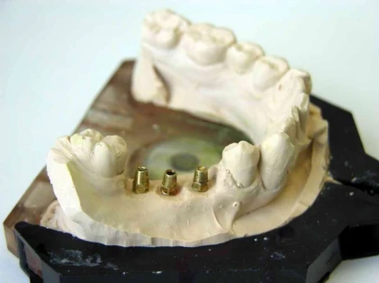 Nanoimplant
