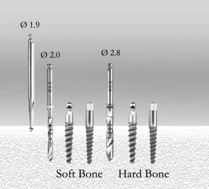 Tidal Ball Implant (TSB)