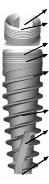 Tidal Spiral Implant System TSI (3.5)