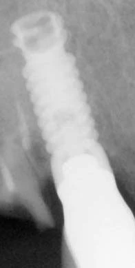 Micro-Vent SD (3.25) (Paragon)