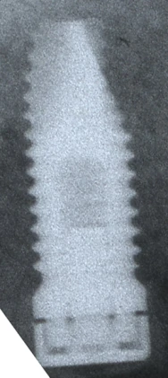Spline Twist (3.75)