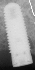 Tapered Screw Vent (3.5)