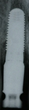 Tapered Screw Vent (4.5)
